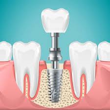 Dental Implants